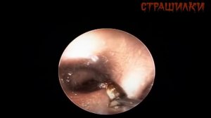 Ужас! 7 Случаев когда Насекомые Залезли в Уши Людям