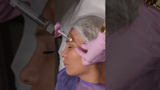 Лифтинг мягких тканей скуловых и височных областей. ПОСТАНОВКА РУКИ смотреть онлайн