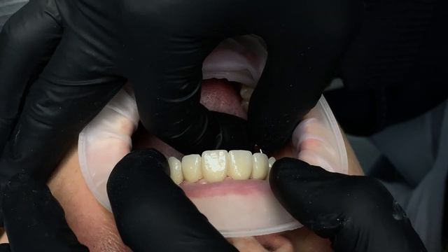 3Shape сканирования тотала.Точность прилегания конструкции подтвержденное рентгеновскими снимками. смотреть онлайн