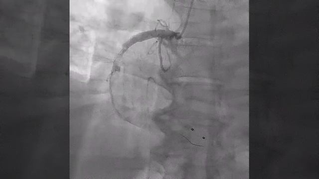 Coronary Angiography Part 3 смотреть онлайн
