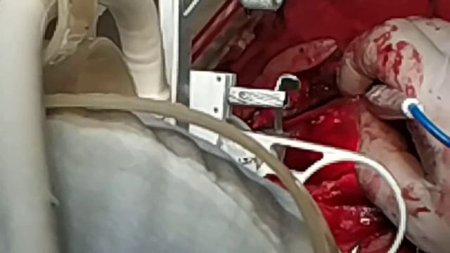 Опухоль основания черепа с прорастанием на лицевой череп смотреть онлайн