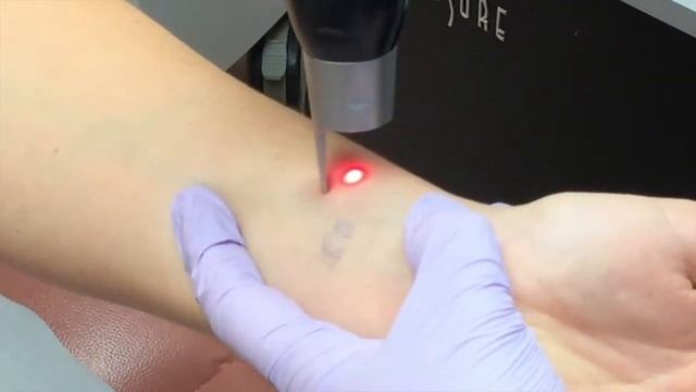 PicoSure Laser Tattoo Removal Treatment at the Langdon Center смотреть онлайн