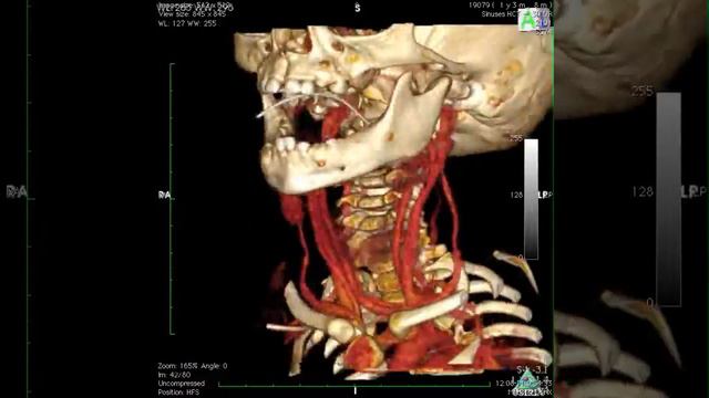 Гемангиома области шеи. 3D КТ реконструкция. смотреть онлайн