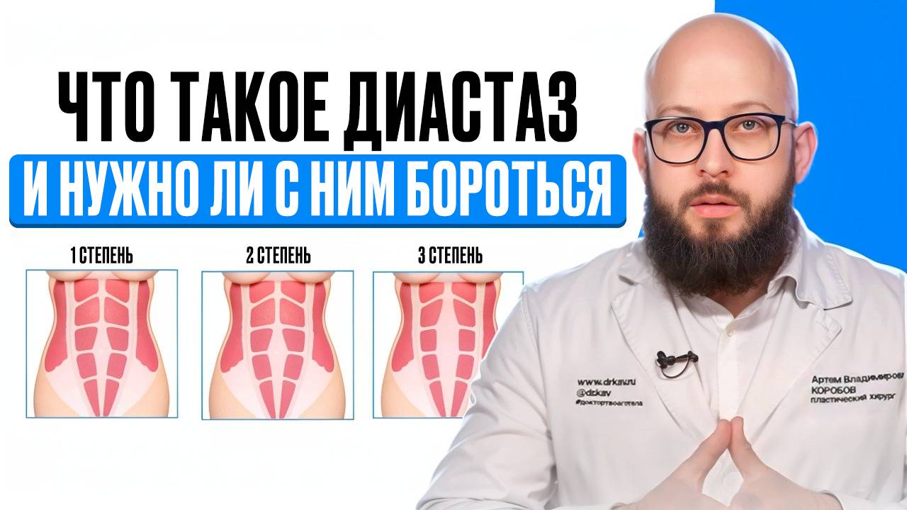 Что делать если у тебя диастаз | Нужно ли с ним бороться смотреть онлайн