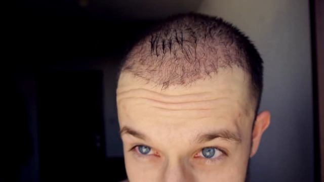 FUE Hair Transplant DAY 87 (post op) Istanbul, Turkey GROWTH STAGE смотреть онлайн