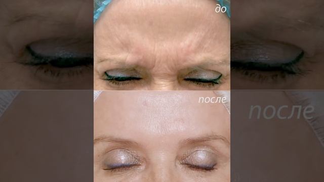 Диспорт-коррекция мимических морщин смотреть онлайн