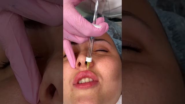 Филлеры. Естественная красота губ. Feel Derli Normal смотреть онлайн