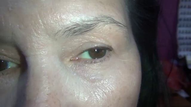 Плазмопен. Заживший результат через неделю после подтяжки верхних век