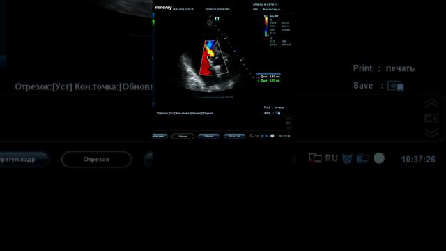 Аортальная недостаточность средней степени