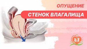 ? Опущение стенок влагалища