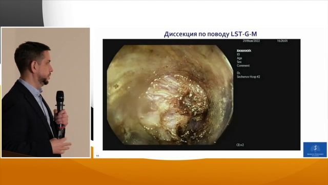 3 Павлов П.В. Роль визуализации в узком спектре в выборе тактики в кишке. Когда удалять не нужно? смотреть онлайн