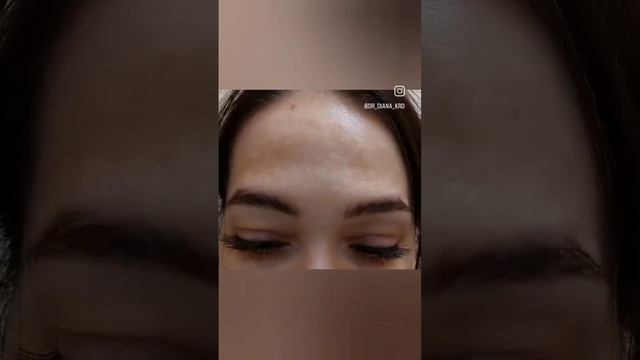 Ботокс до и после через 2 недели .  Мимика сохранна ,  нет морщин и нет лица- маски .