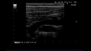 Норма - подключичная артерия и вена.