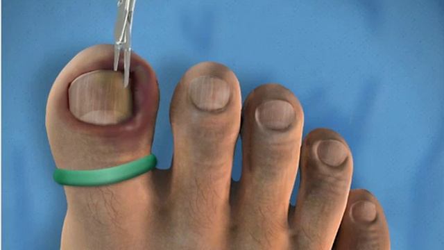 Очень веселая игра, удаляем ноготь! смотреть онлайн