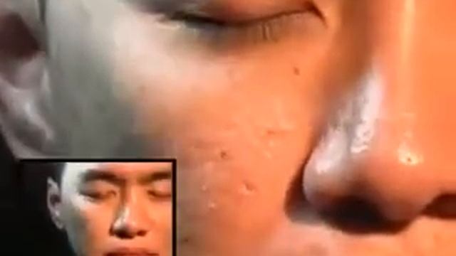 Лицевые клещи Demodex смотреть онлайн