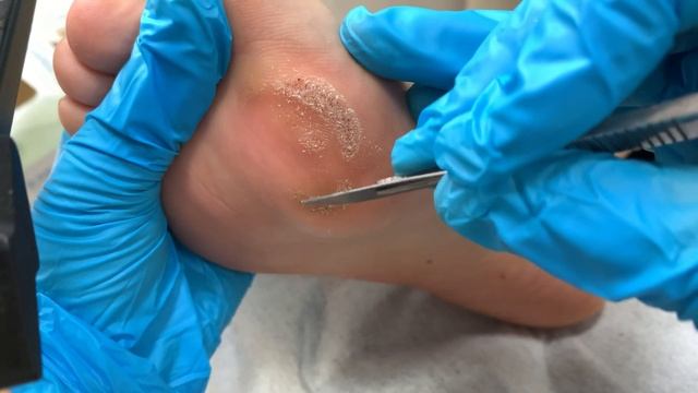 Crescent-shaped calluses/scratch off with a knife【Xiao Yan Pedicure】 смотреть онлайн