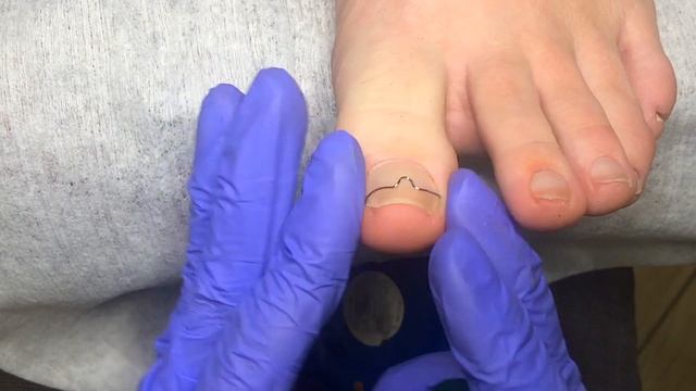 Вросший ноготь на ноге ⚡ЧТО ДЕЛАТЬ? Советы профессионала