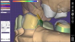 EXOCAD моделировка каркаса под замковый бюгельный протез. немного помучился)))
