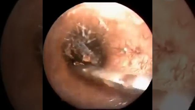 ушные болезни. Серная пробка, инородное тело в ушном походе. смотреть онлайн