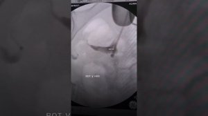 Проходимость маточных труб