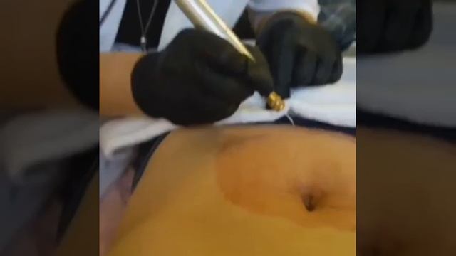Удаление растяжек аппаратом fibroblast смотреть онлайн