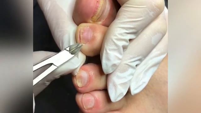 Врастание ногтей