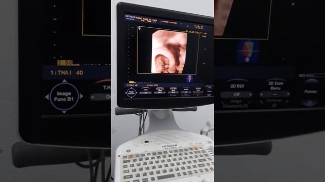 Thoát vị rốn 4d смотреть онлайн