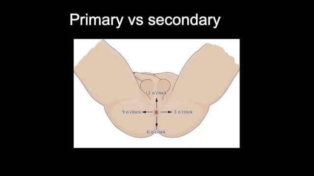 Doctor explains ANAL FISSURE, including causes, classification and treatment options смотреть онлайн