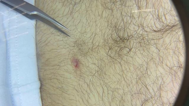 Удаление вросших волос смотреть онлайн