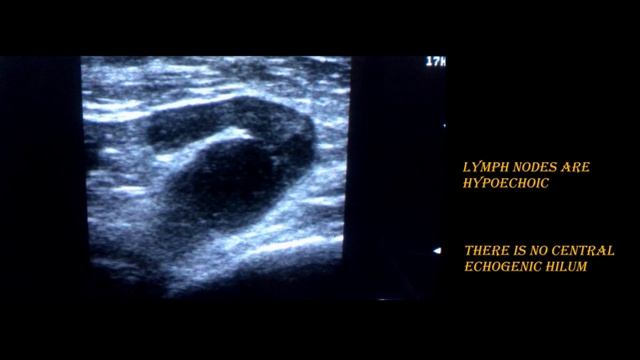 Ultrasonography Tutorial- Breast Lump video смотреть онлайн