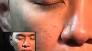 Лицевые клещи Demodex