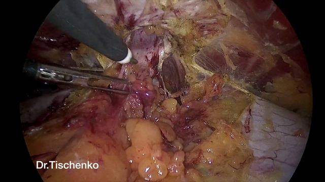 eTEP RS repair of a Umbilical Hernia. Лечение пупочной грыжи смотреть онлайн