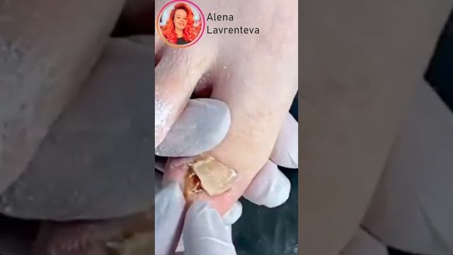 Хочешь посмотреть что на второй ноге? Ссылка на видео в описании! #Nails #Ногти #вросший ноготь