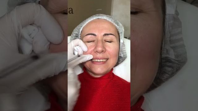 Инъекции Ботокса в Губы в Краснодаре смотреть онлайн