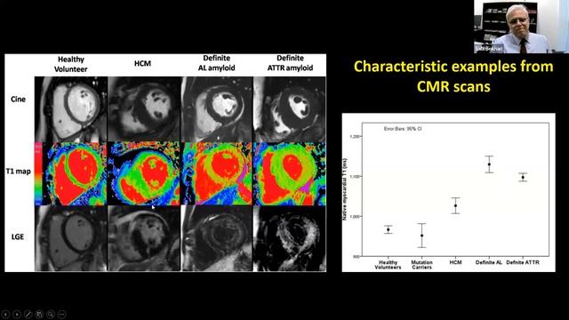 Cardiac Amyloidosis – The Great Masquerader смотреть онлайн