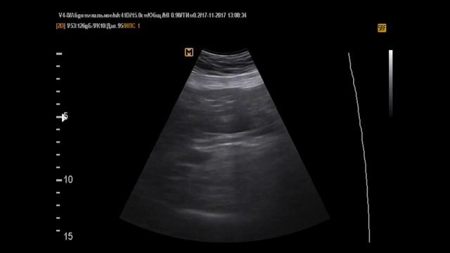 2 случая аневризмы БОА(17-11-17)
