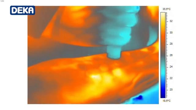 Motus AX – Världens Effektivaste Hårborttagningslaser