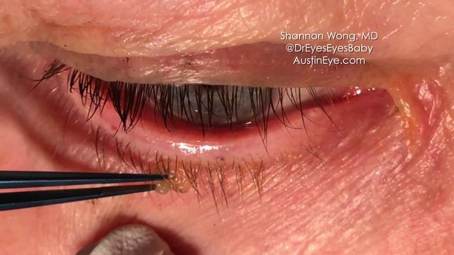 Excision of eyelid papilloma. 9-12-16. Shannon Wong, MD смотреть онлайн