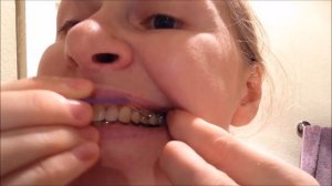 Как надеть ортодонтические эластики/резинки/тяги при помощи крючка