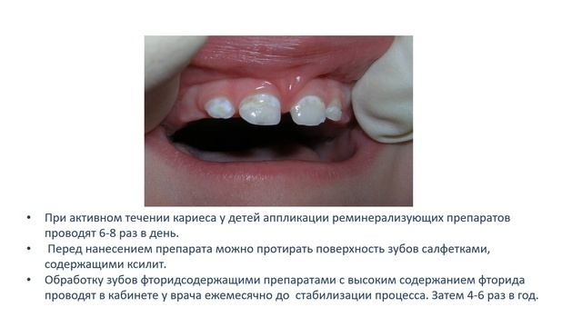 Кариес зубов у детей лекция