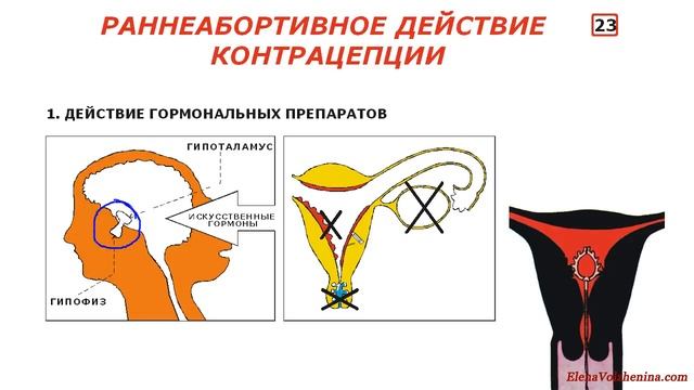 Восстановление плодности после удаления спирали, Урок4 смотреть онлайн