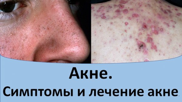Акне. Симптомы и лечение акне.