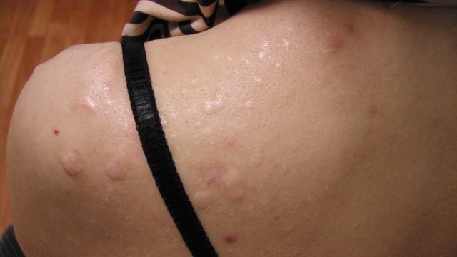 Почему появляются прыщи на спине?