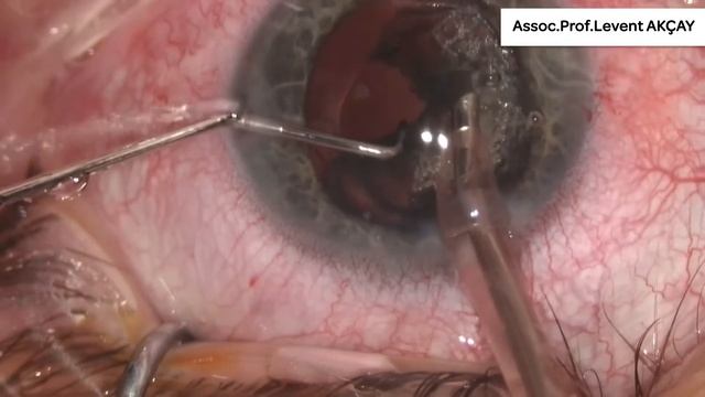 FINEVISION TORIC (POD FT) implantation by Pr. Akçay смотреть онлайн