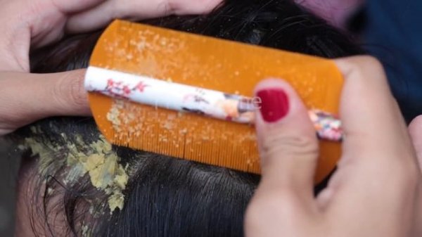 Removal Dandruff Flakes With Lice Comb | Psoriasis Flakes Scalp (Huge Flakes) 150