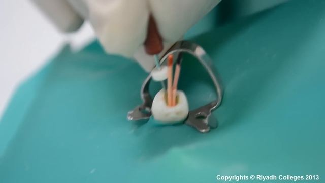 The Lateral Condensation Technique In 30 Steps