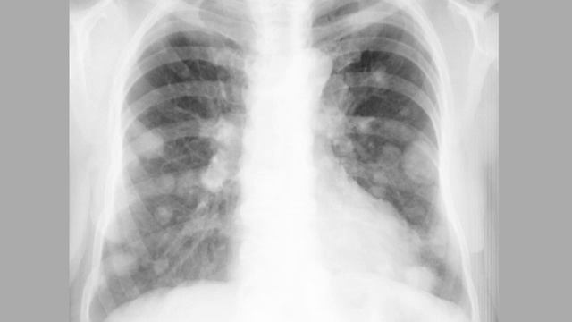 Круглые тени на снимке легких смотреть онлайн