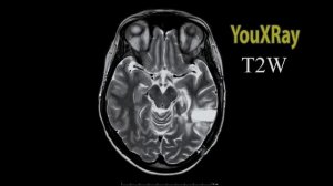 Базовые лекции по МРТ / МР-последовательности: T2W