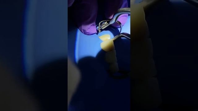 Реставрация зуба , постановка пломбы на зуб , лечение кариеса на зубе , замена пломбы , лечение зуб смотреть онлайн