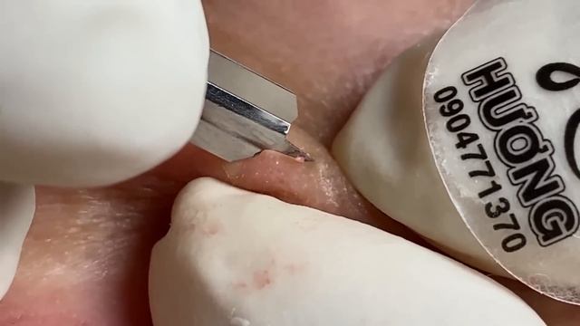 Make your Acne Treatment Huong Da Nang#502 | acne 2022 PArt 1 смотреть онлайн